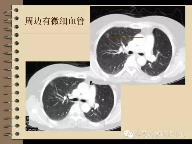 【PPT】早期肺癌影像诊断