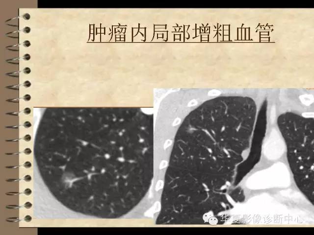 【PPT】早期肺癌影像诊断