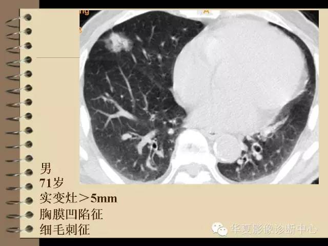 【PPT】早期肺癌影像诊断