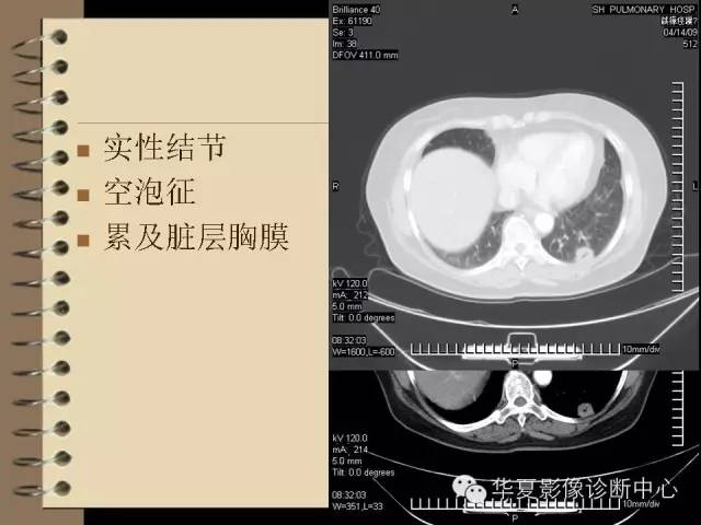 【PPT】早期肺癌影像诊断