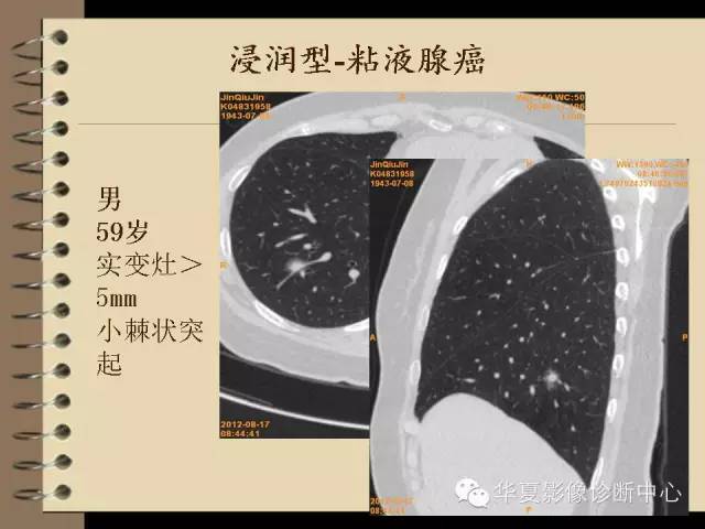 【PPT】早期肺癌影像诊断