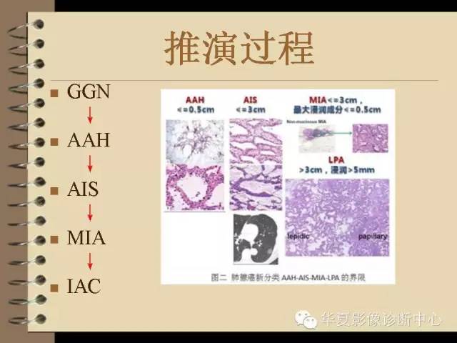 【PPT】早期肺癌影像诊断