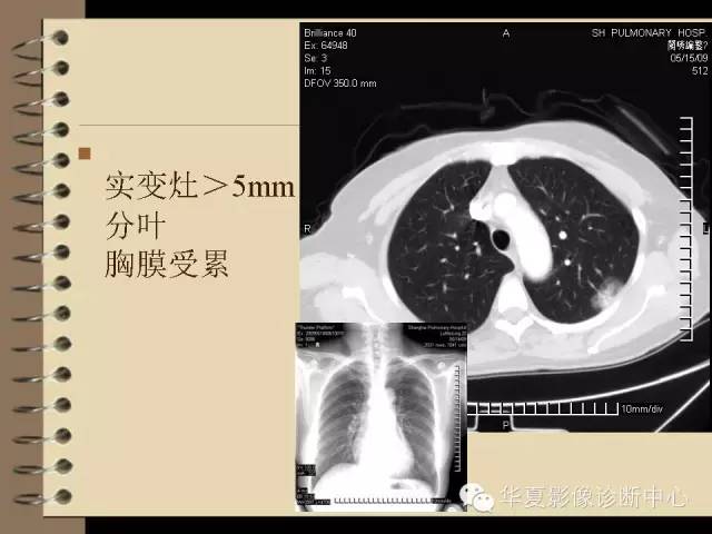 【PPT】早期肺癌影像诊断