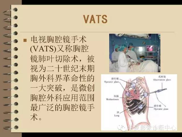 【PPT】早期肺癌影像诊断