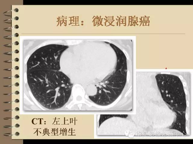 【PPT】早期肺癌影像诊断