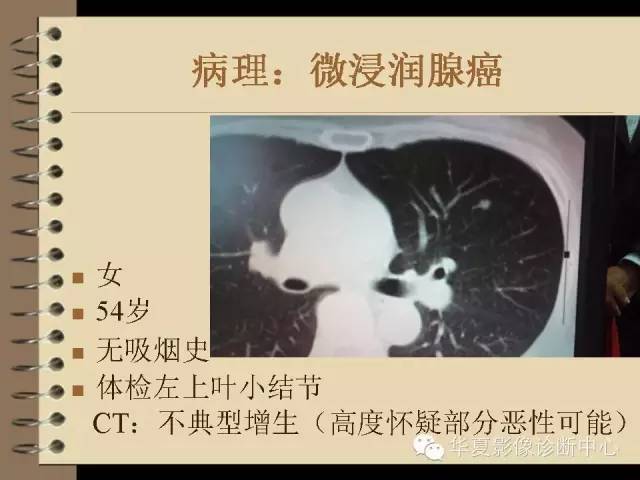 【PPT】早期肺癌影像诊断