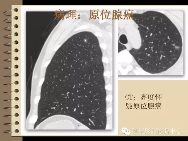 【PPT】早期肺癌影像诊断