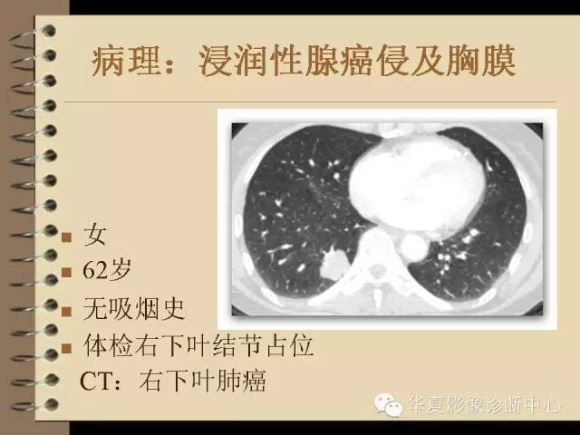 【PPT】早期肺癌影像诊断