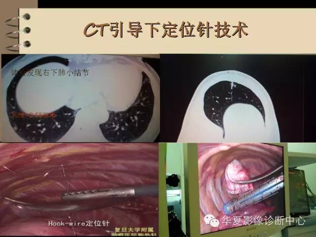 【PPT】早期肺癌影像诊断