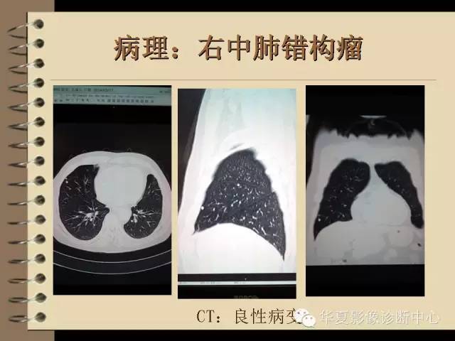 【PPT】早期肺癌影像诊断