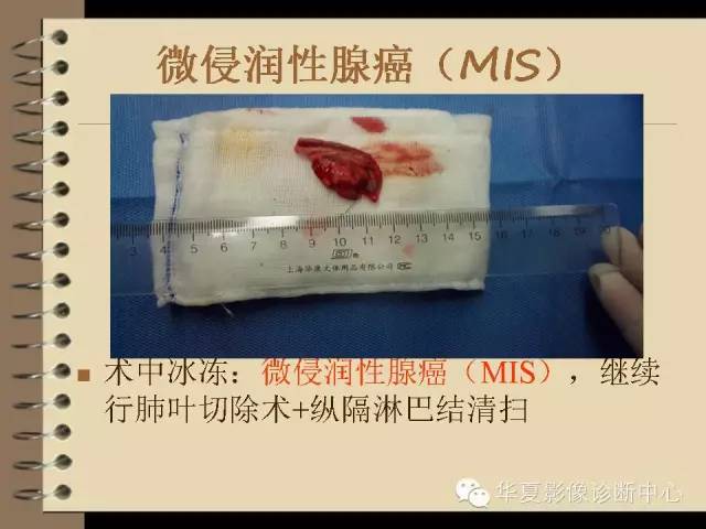 【PPT】早期肺癌影像诊断