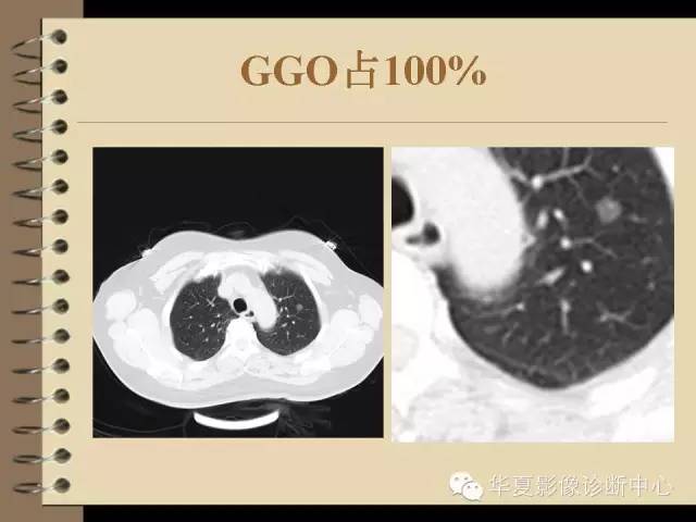 【PPT】早期肺癌影像诊断