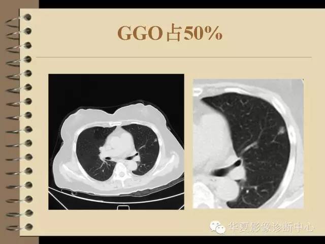 【PPT】早期肺癌影像诊断