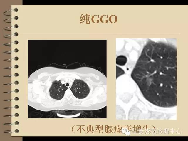 【PPT】早期肺癌影像诊断