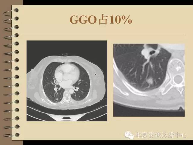 【PPT】早期肺癌影像诊断