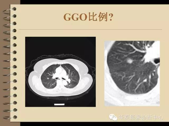 【PPT】早期肺癌影像诊断