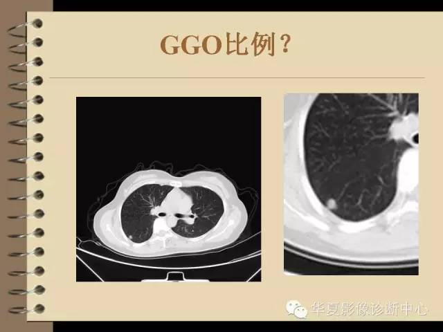 【PPT】早期肺癌影像诊断