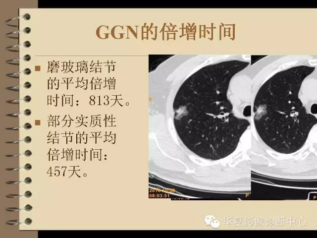 【PPT】早期肺癌影像诊断