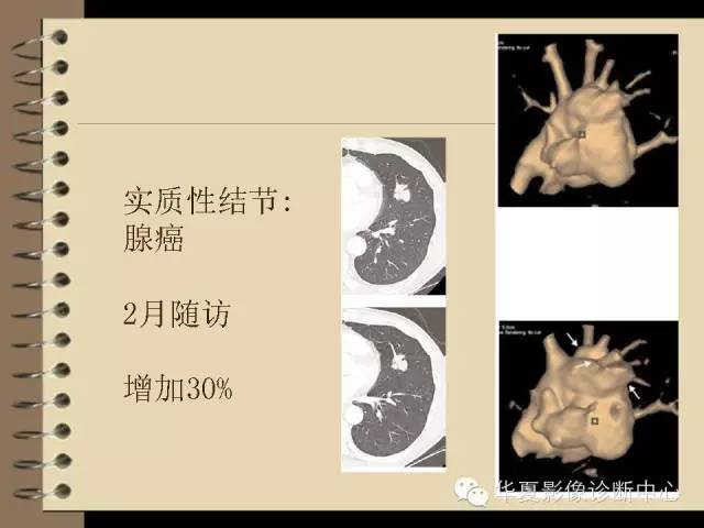 【PPT】早期肺癌影像诊断