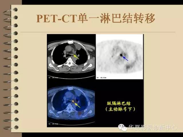 【PPT】早期肺癌影像诊断