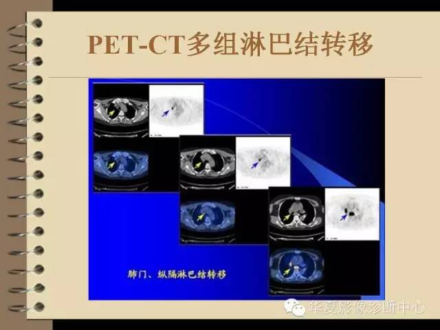 【PPT】早期肺癌影像诊断