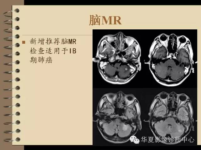 【PPT】早期肺癌影像诊断