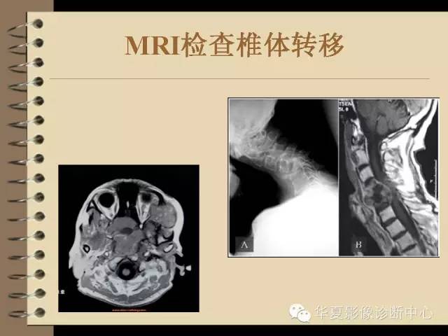 【PPT】早期肺癌影像诊断