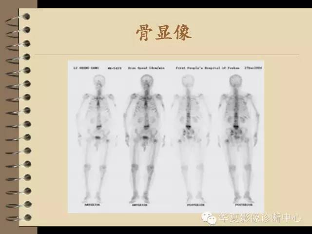 【PPT】早期肺癌影像诊断