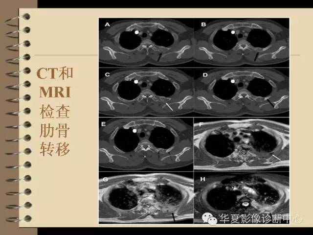 【PPT】早期肺癌影像诊断