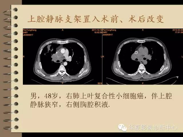 【PPT】早期肺癌影像诊断