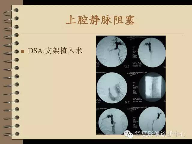 【PPT】早期肺癌影像诊断