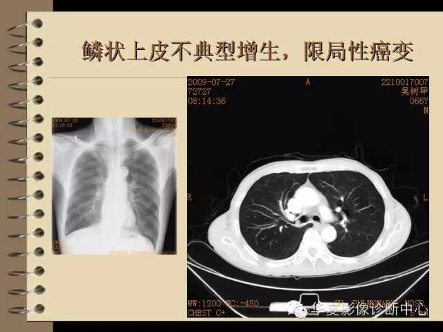 【PPT】早期肺癌影像诊断