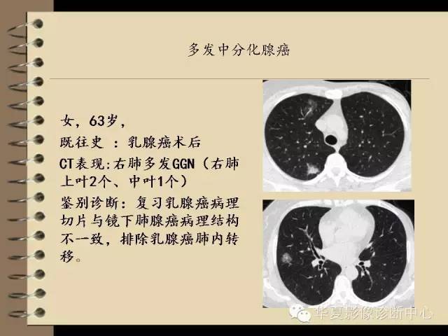 【PPT】早期肺癌影像诊断