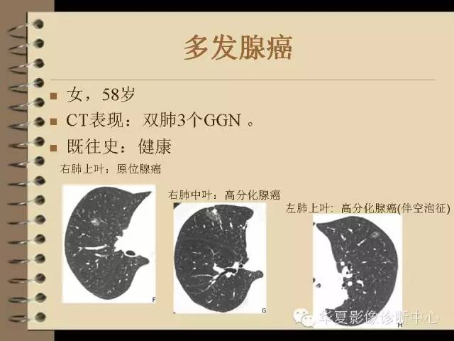 【PPT】早期肺癌影像诊断