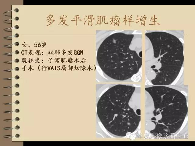 【PPT】早期肺癌影像诊断
