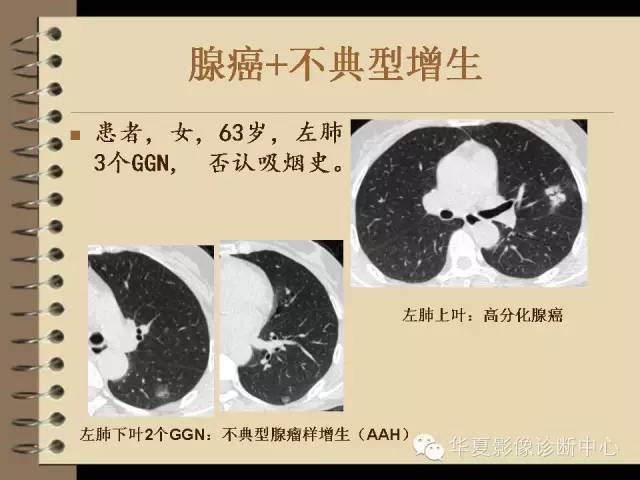 【PPT】早期肺癌影像诊断