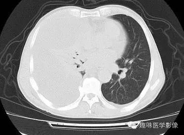 【病例】周围型肺癌1例CT影像特点
