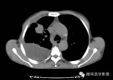 【病例】周围型肺癌1例CT影像特点