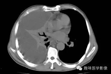 【病例】周围型肺癌1例CT影像特点