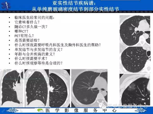 【PPT】亚实性肺结节—影像诊断医师和临床医师必知内容
