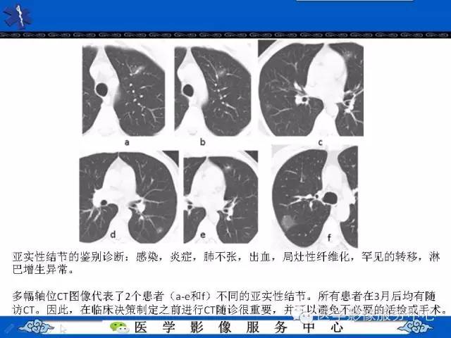 【PPT】亚实性肺结节—影像诊断医师和临床医师必知内容