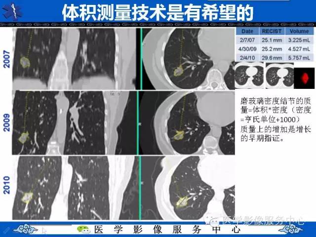 【PPT】亚实性肺结节—影像诊断医师和临床医师必知内容