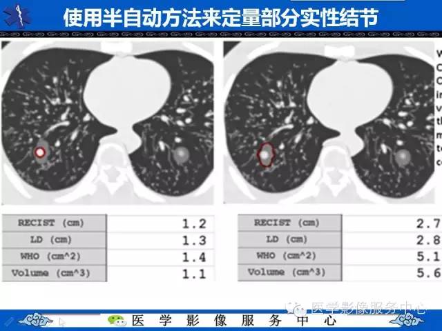 【PPT】亚实性肺结节—影像诊断医师和临床医师必知内容