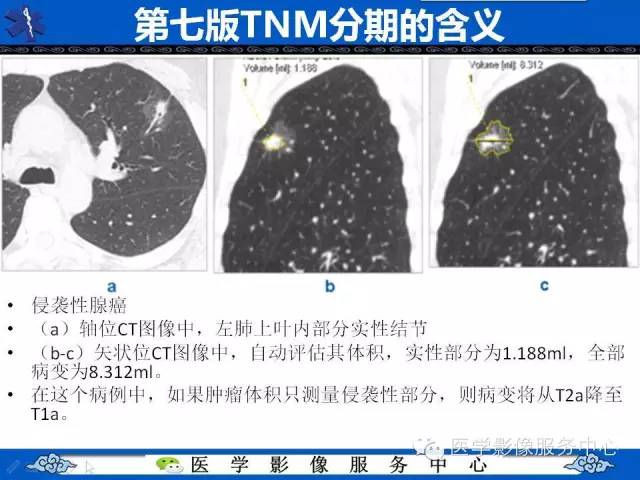 【PPT】亚实性肺结节—影像诊断医师和临床医师必知内容