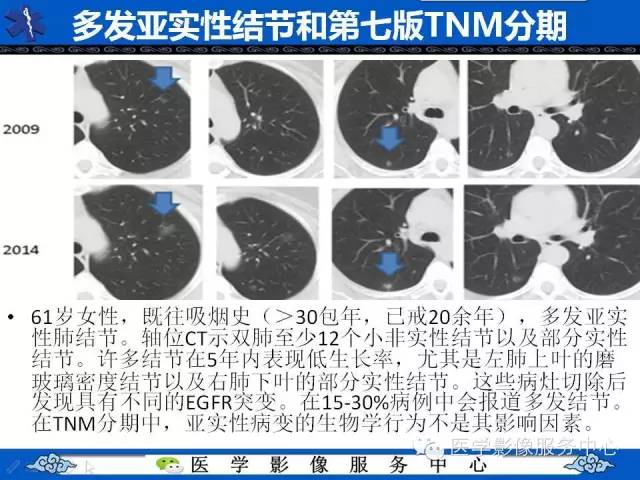 【PPT】亚实性肺结节—影像诊断医师和临床医师必知内容