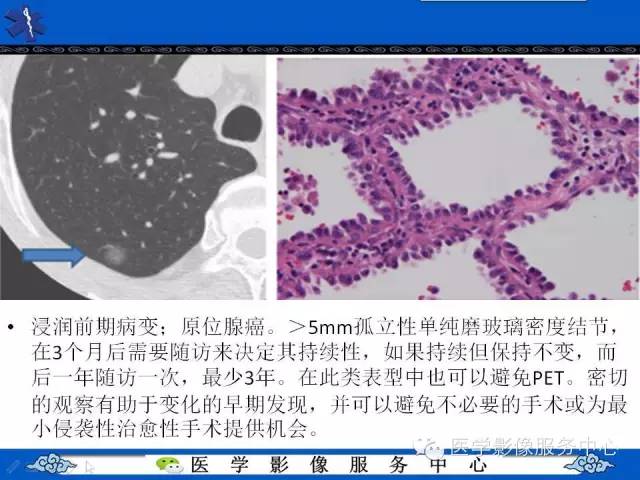 【PPT】亚实性肺结节—影像诊断医师和临床医师必知内容