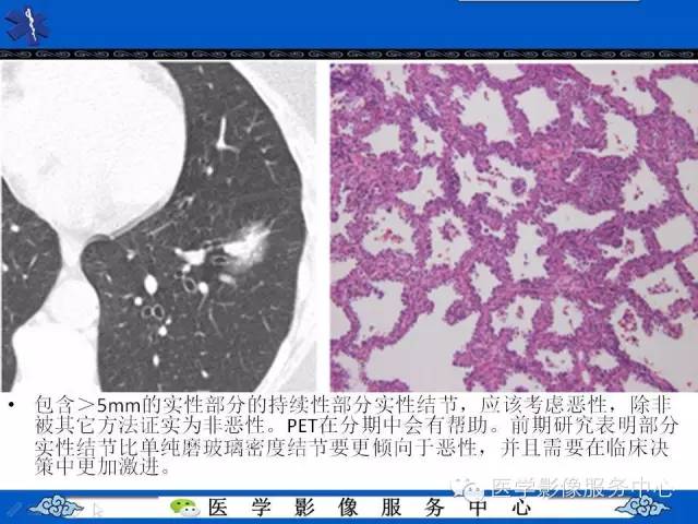 【PPT】亚实性肺结节—影像诊断医师和临床医师必知内容