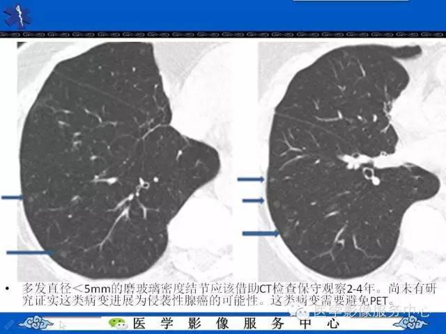 【PPT】亚实性肺结节—影像诊断医师和临床医师必知内容