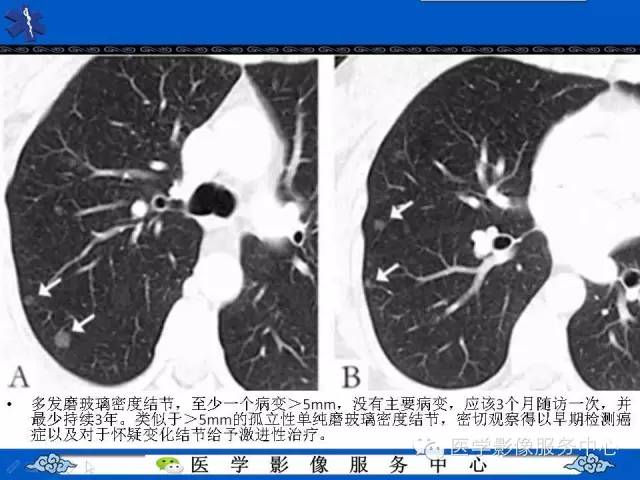 【PPT】亚实性肺结节—影像诊断医师和临床医师必知内容