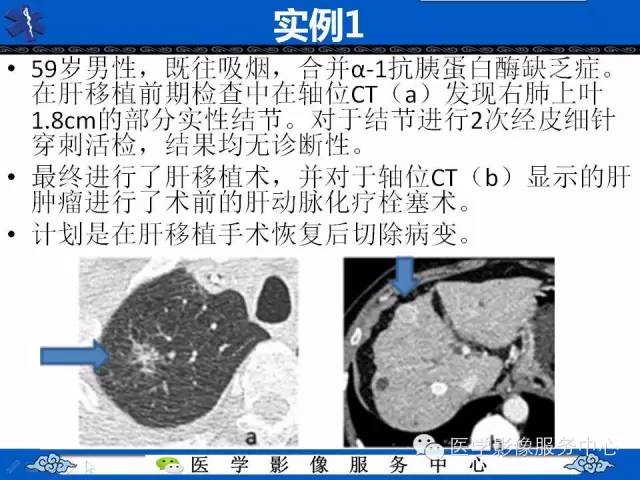【PPT】亚实性肺结节—影像诊断医师和临床医师必知内容